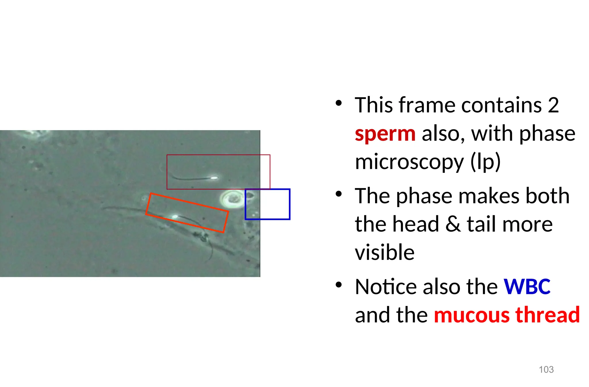 103
• This frame contains 2
sperm also, with phase
microscopy (lp)
• The phase makes both
the head & tail more
visible
• Notice also the WBC
and the mucous thread
 