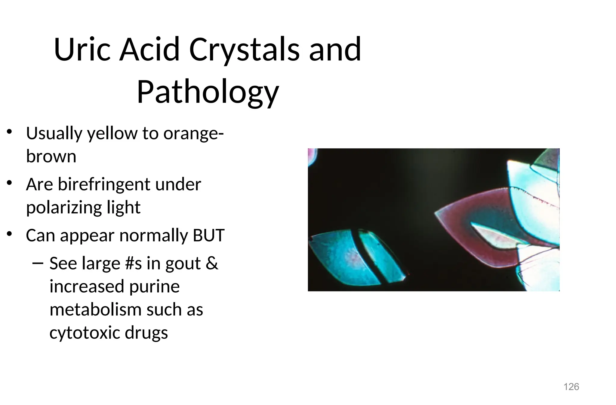 126
Uric Acid Crystals and
Pathology
• Usually yellow to orange-
brown
• Are birefringent under
polarizing light
• Can appear normally BUT
– See large #s in gout &
increased purine
metabolism such as
cytotoxic drugs
 