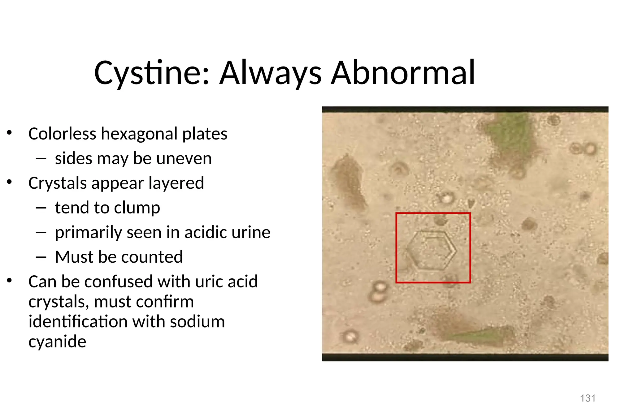131
Cystine: Always Abnormal
• Colorless hexagonal plates
– sides may be uneven
• Crystals appear layered
– tend to clump
– primarily seen in acidic urine
– Must be counted
• Can be confused with uric acid
crystals, must confirm
identification with sodium
cyanide
 