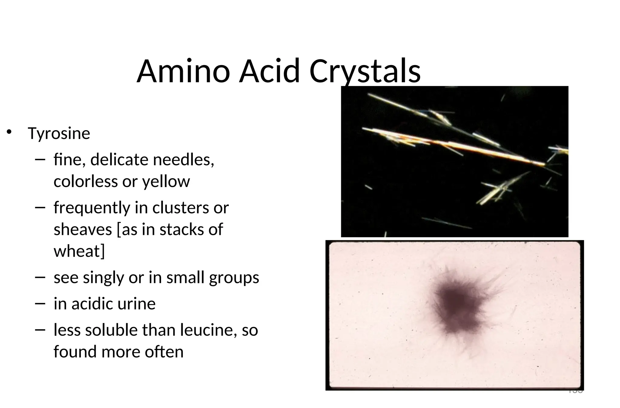 133
Amino Acid Crystals
• Tyrosine
– fine, delicate needles,
colorless or yellow
– frequently in clusters or
sheaves [as in stacks of
wheat]
– see singly or in small groups
– in acidic urine
– less soluble than leucine, so
found more often
 