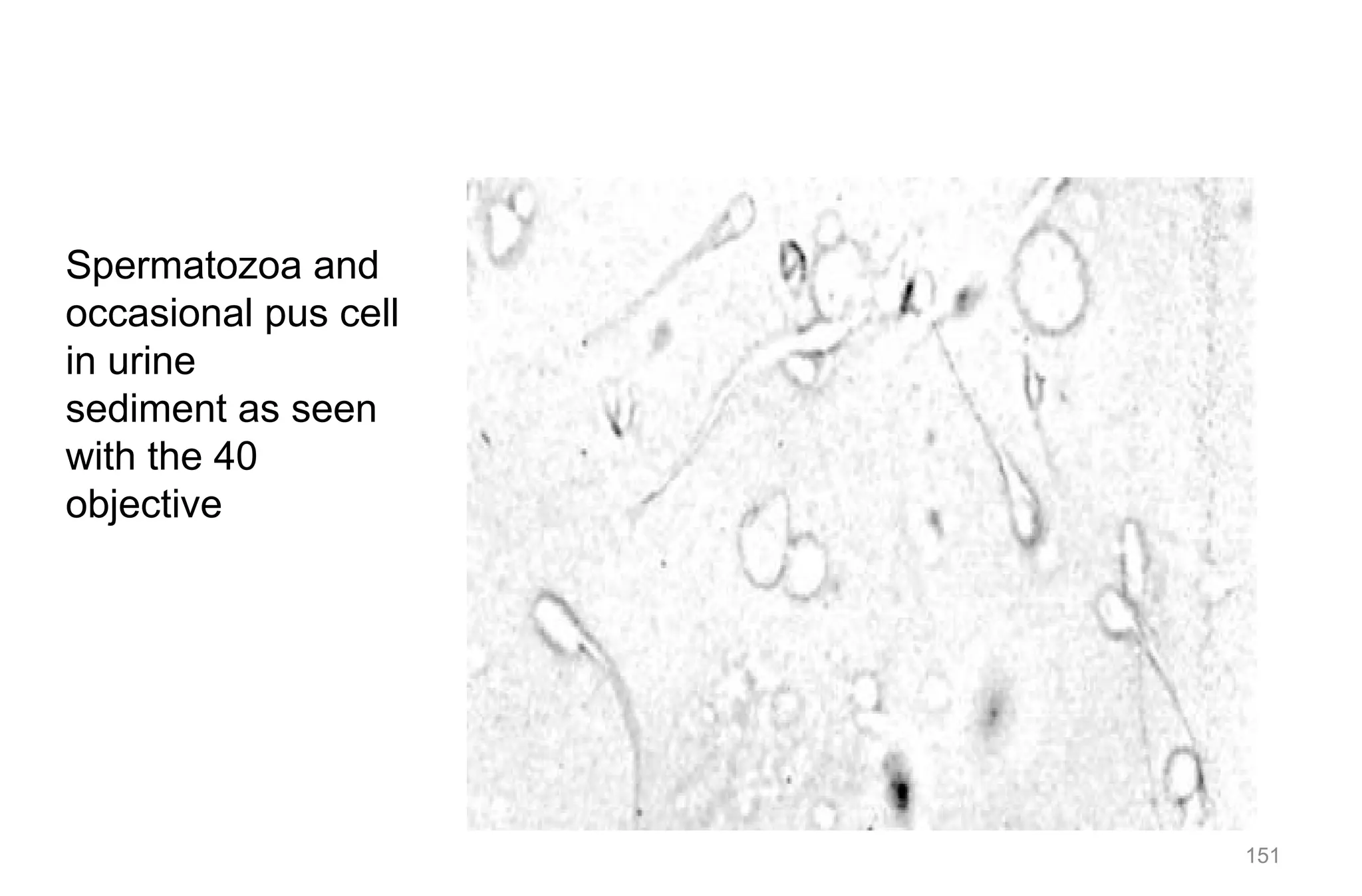 151
Spermatozoa and
occasional pus cell
in urine
sediment as seen
with the 40
objective
 