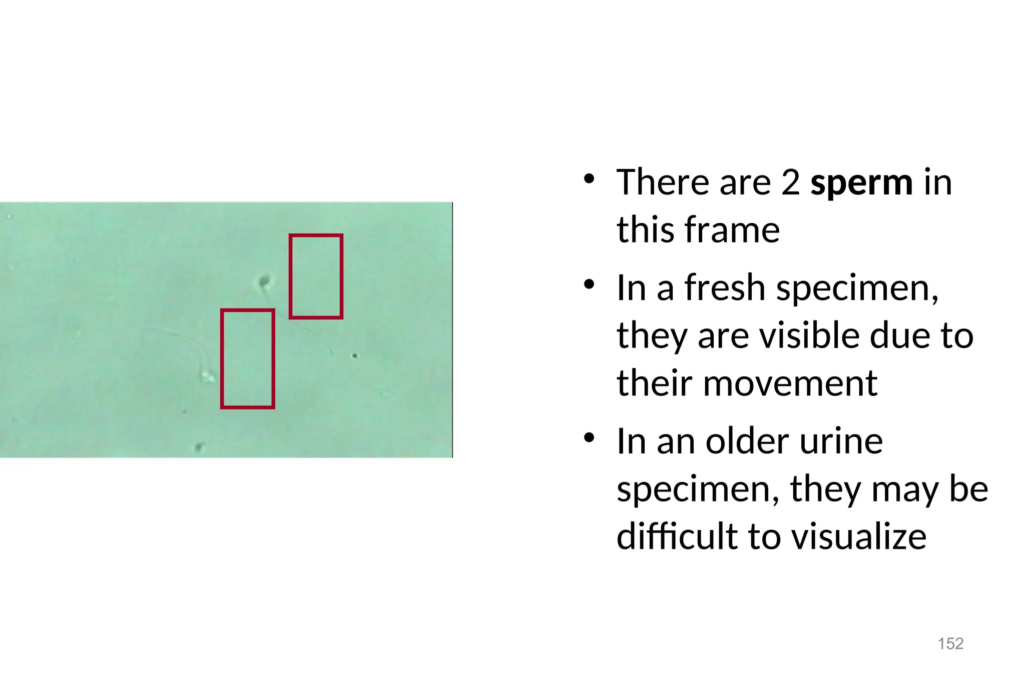 152
• There are 2 sperm in
this frame
• In a fresh specimen,
they are visible due to
their movement
• In an older urine
specimen, they may be
difficult to visualize
 