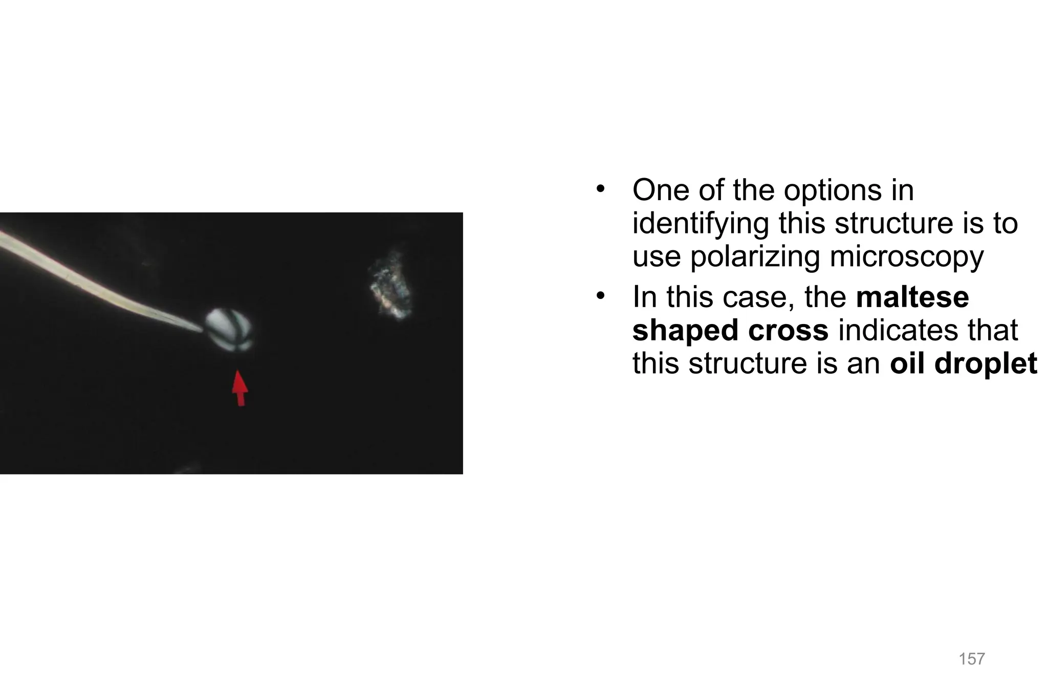 157
• One of the options in
identifying this structure is to
use polarizing microscopy
• In this case, the maltese
shaped cross indicates that
this structure is an oil droplet
 