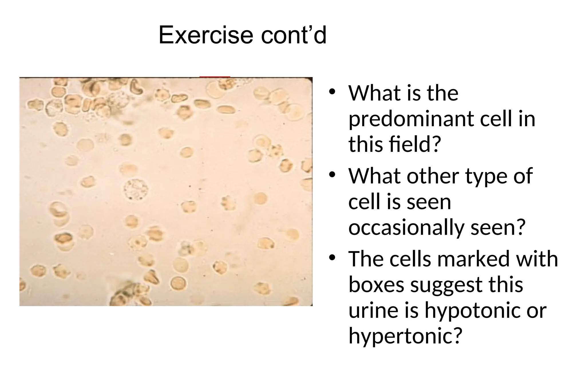 • What is the
predominant cell in
this field?
• What other type of
cell is seen
occasionally seen?
• The cells marked with
boxes suggest this
urine is hypotonic or
hypertonic?
Exercise cont’d
 