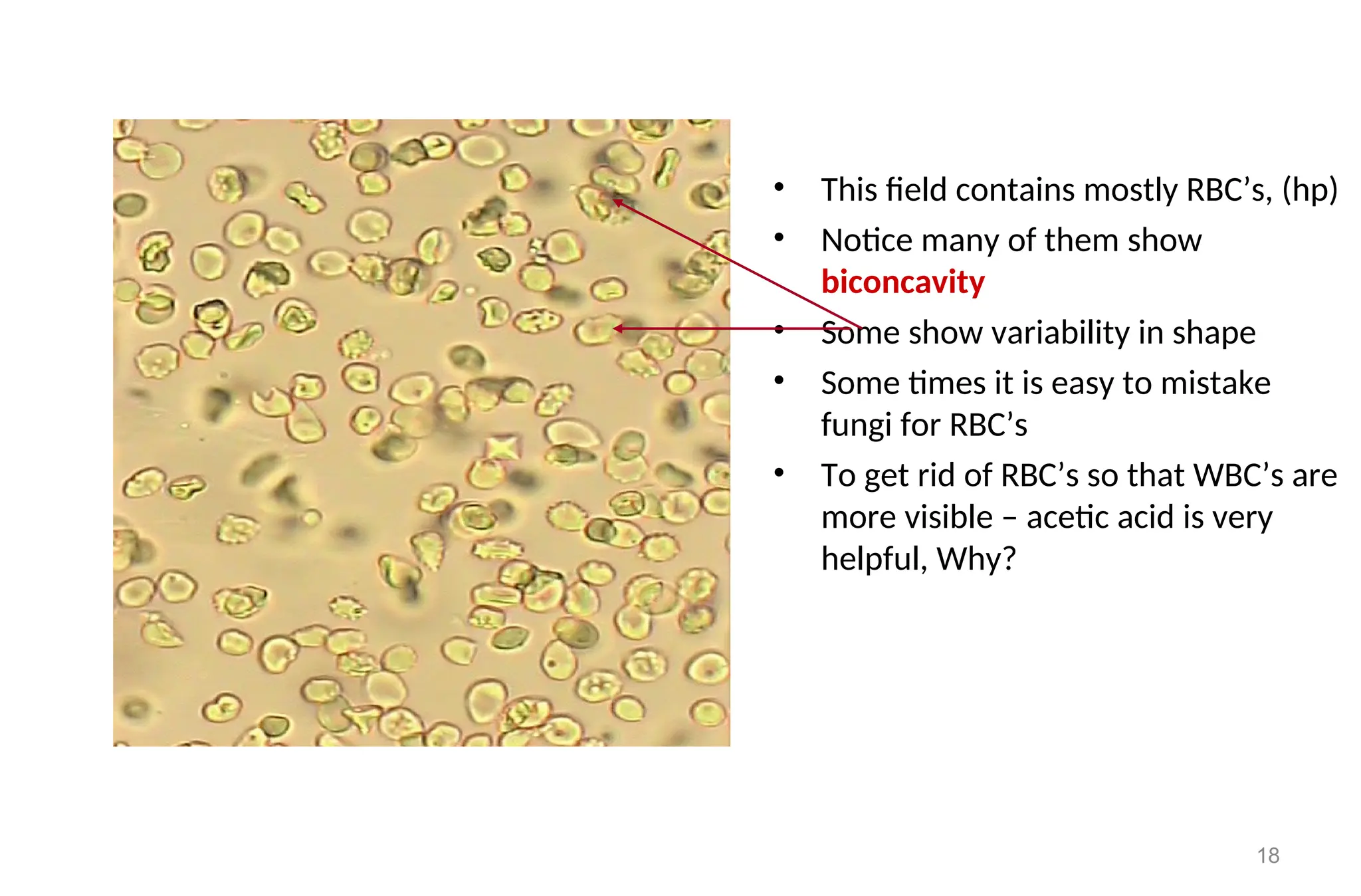 18
• This field contains mostly RBC’s, (hp)
• Notice many of them show
biconcavity
• Some show variability in shape
• Some times it is easy to mistake
fungi for RBC’s
• To get rid of RBC’s so that WBC’s are
more visible – acetic acid is very
helpful, Why?
 