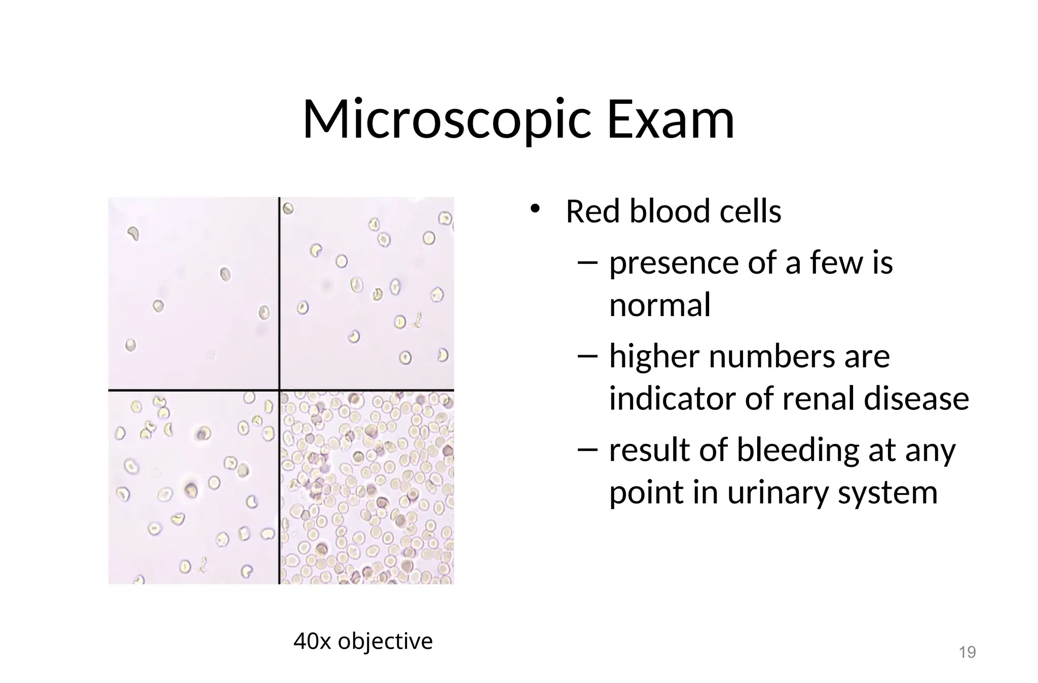 Microscopic Exam
• Red blood cells
– presence of a few is
normal
– higher numbers are
indicator of renal disease
– result of bleeding at any
point in urinary system
19
40x objective
 
