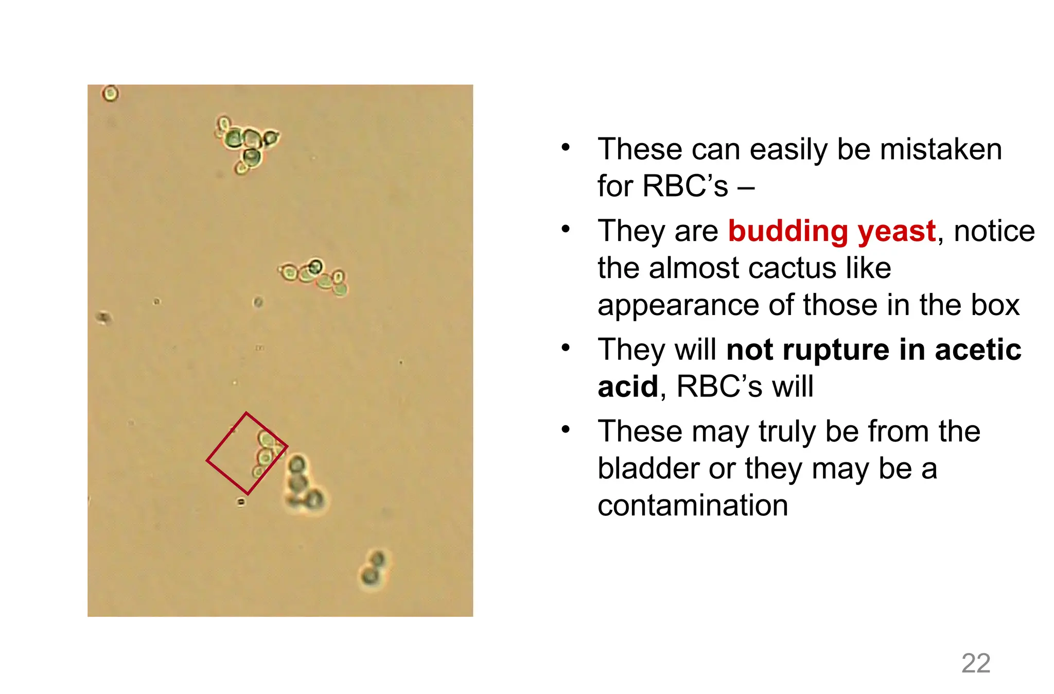 22
• These can easily be mistaken
for RBC’s –
• They are budding yeast, notice
the almost cactus like
appearance of those in the box
• They will not rupture in acetic
acid, RBC’s will
• These may truly be from the
bladder or they may be a
contamination
 