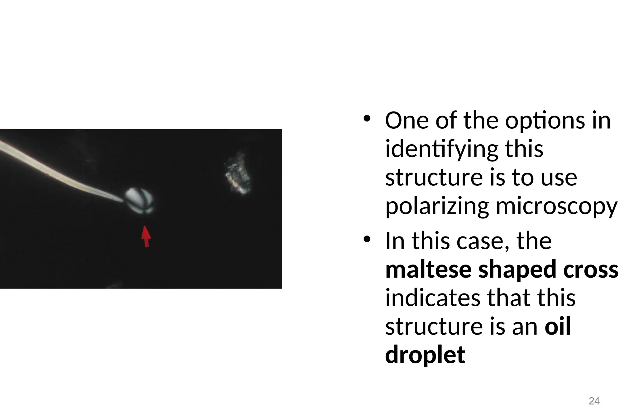 24
• One of the options in
identifying this
structure is to use
polarizing microscopy
• In this case, the
maltese shaped cross
indicates that this
structure is an oil
droplet
 