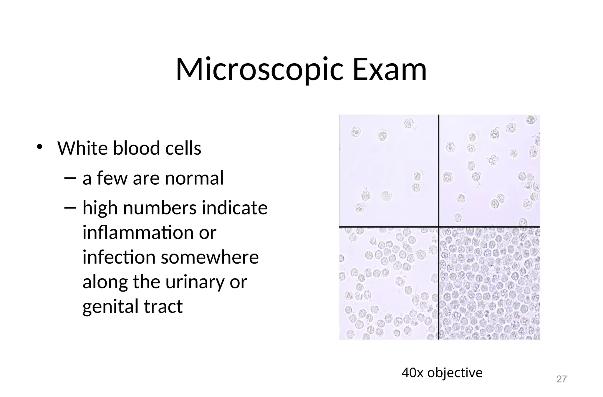 Microscopic Exam
• White blood cells
– a few are normal
– high numbers indicate
inflammation or
infection somewhere
along the urinary or
genital tract
27
40x objective
 