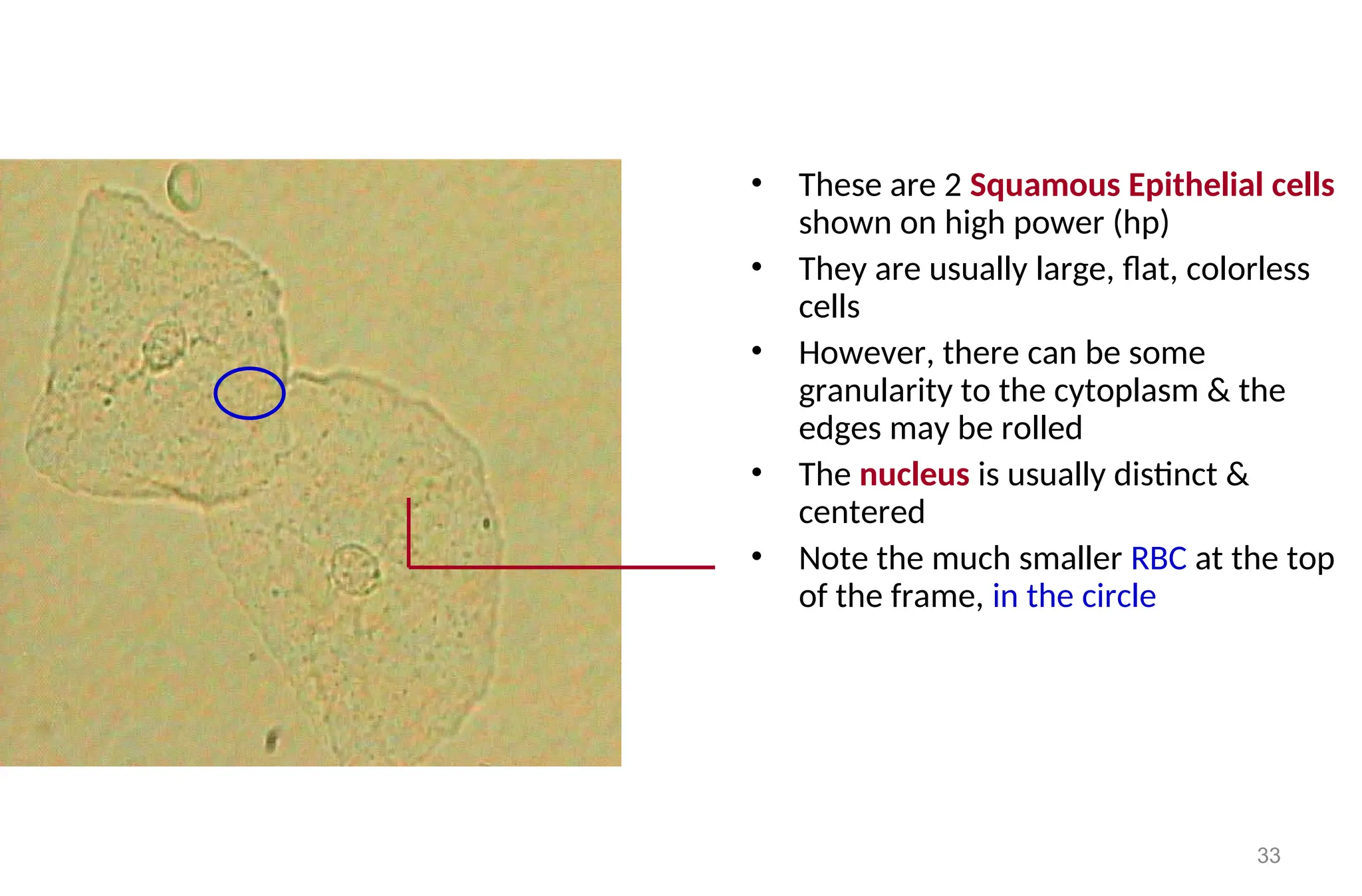 33
• These are 2 Squamous Epithelial cells
shown on high power (hp)
• They are usually large, flat, colorless
cells
• However, there can be some
granularity to the cytoplasm & the
edges may be rolled
• The nucleus is usually distinct &
centered
• Note the much smaller RBC at the top
of the frame, in the circle
 