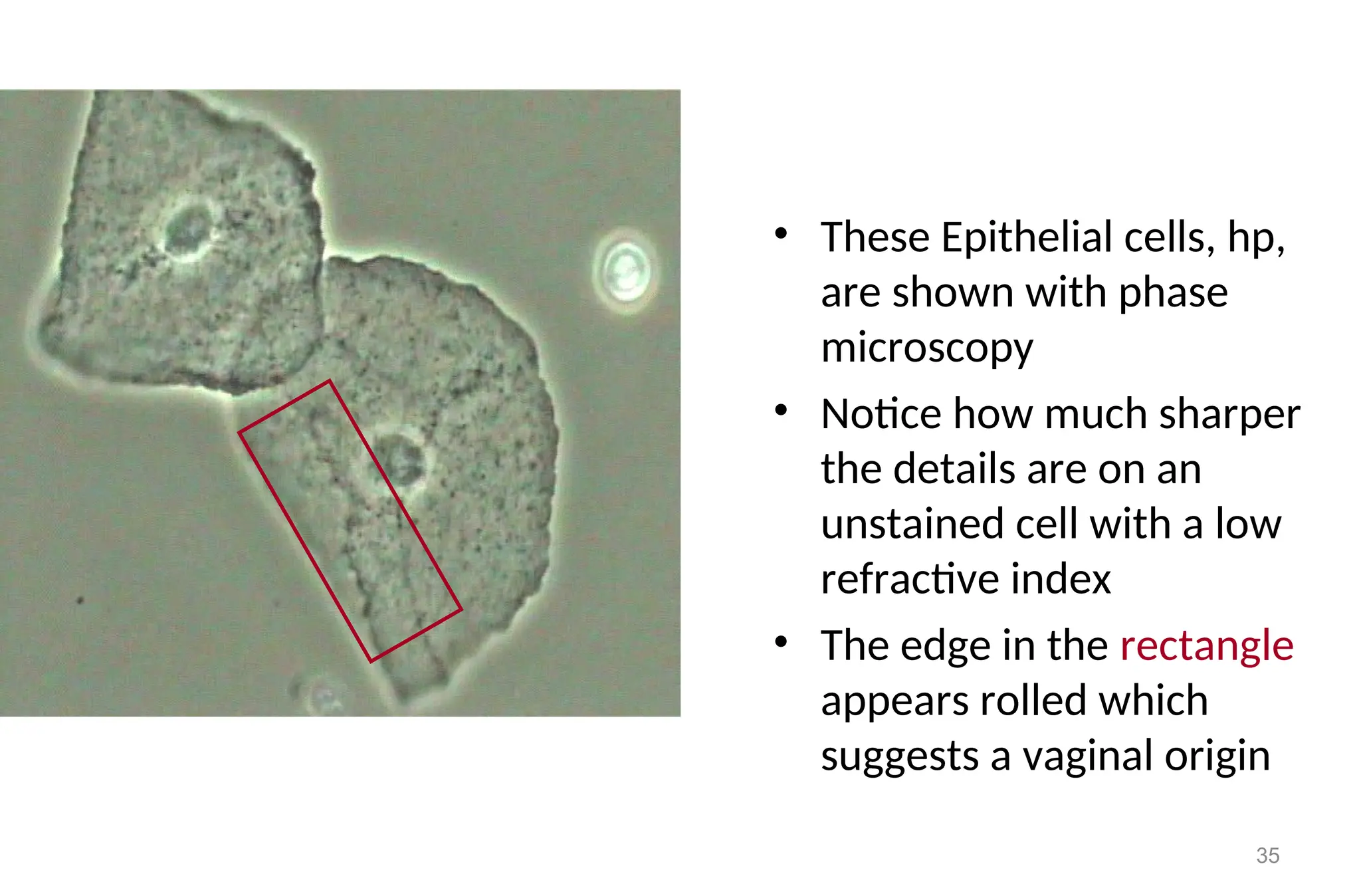 35
• These Epithelial cells, hp,
are shown with phase
microscopy
• Notice how much sharper
the details are on an
unstained cell with a low
refractive index
• The edge in the rectangle
appears rolled which
suggests a vaginal origin
 