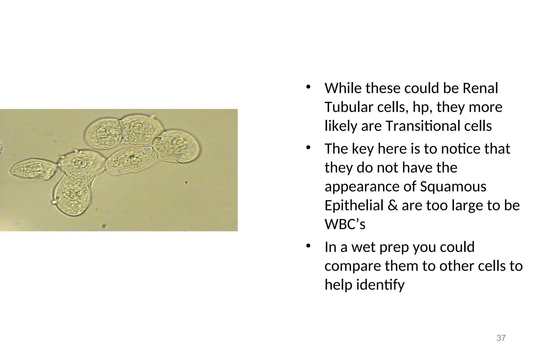 37
• While these could be Renal
Tubular cells, hp, they more
likely are Transitional cells
• The key here is to notice that
they do not have the
appearance of Squamous
Epithelial & are too large to be
WBC’s
• In a wet prep you could
compare them to other cells to
help identify
 