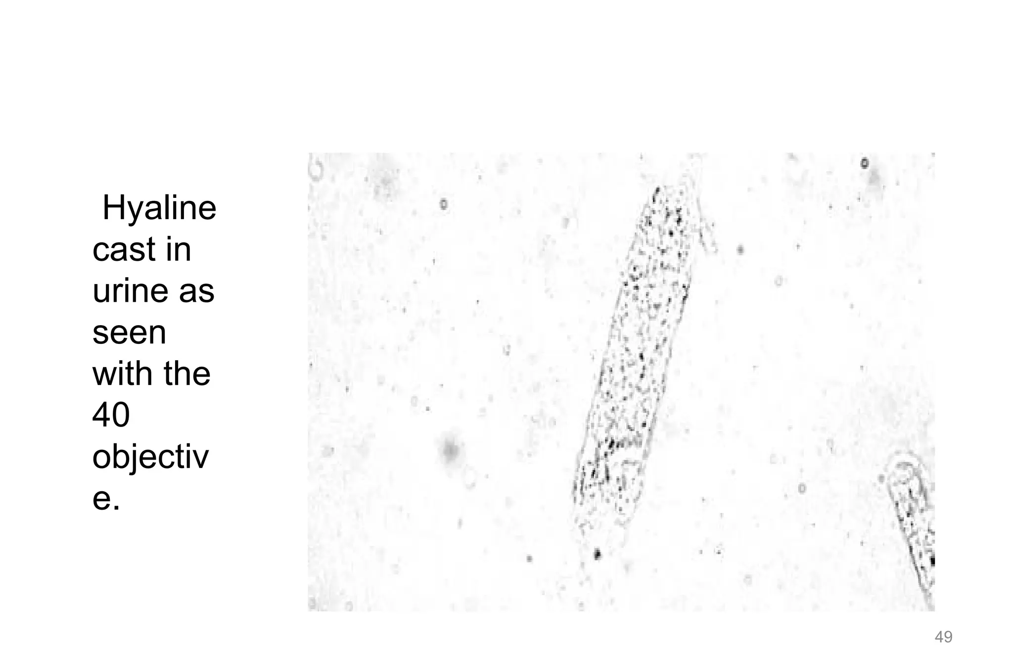 49
Hyaline
cast in
urine as
seen
with the
40
objectiv
e.
 