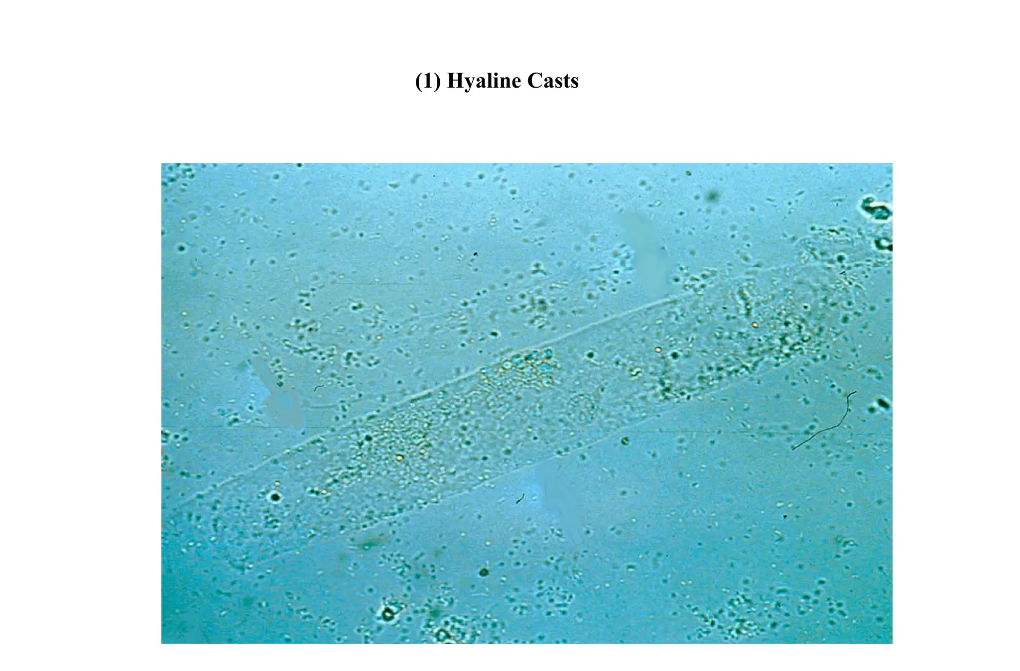 (1) Hyaline Casts
 