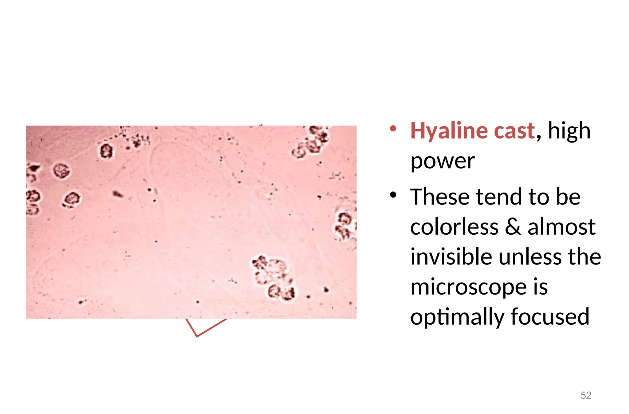 • Hyaline cast, high
power
• These tend to be
colorless & almost
invisible unless the
microscope is
optimally focused
52
 
