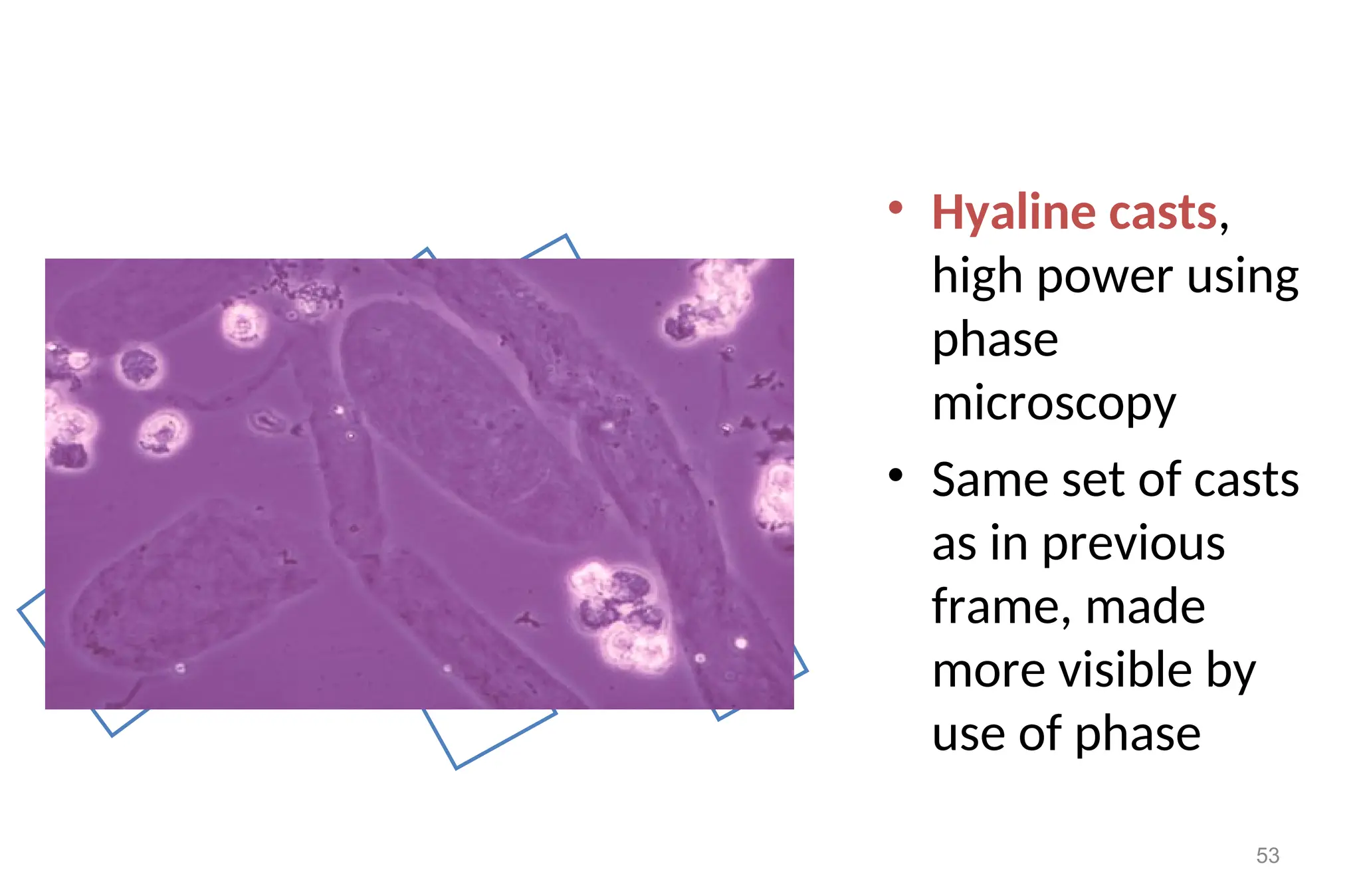 • Hyaline casts,
high power using
phase
microscopy
• Same set of casts
as in previous
frame, made
more visible by
use of phase
53
 