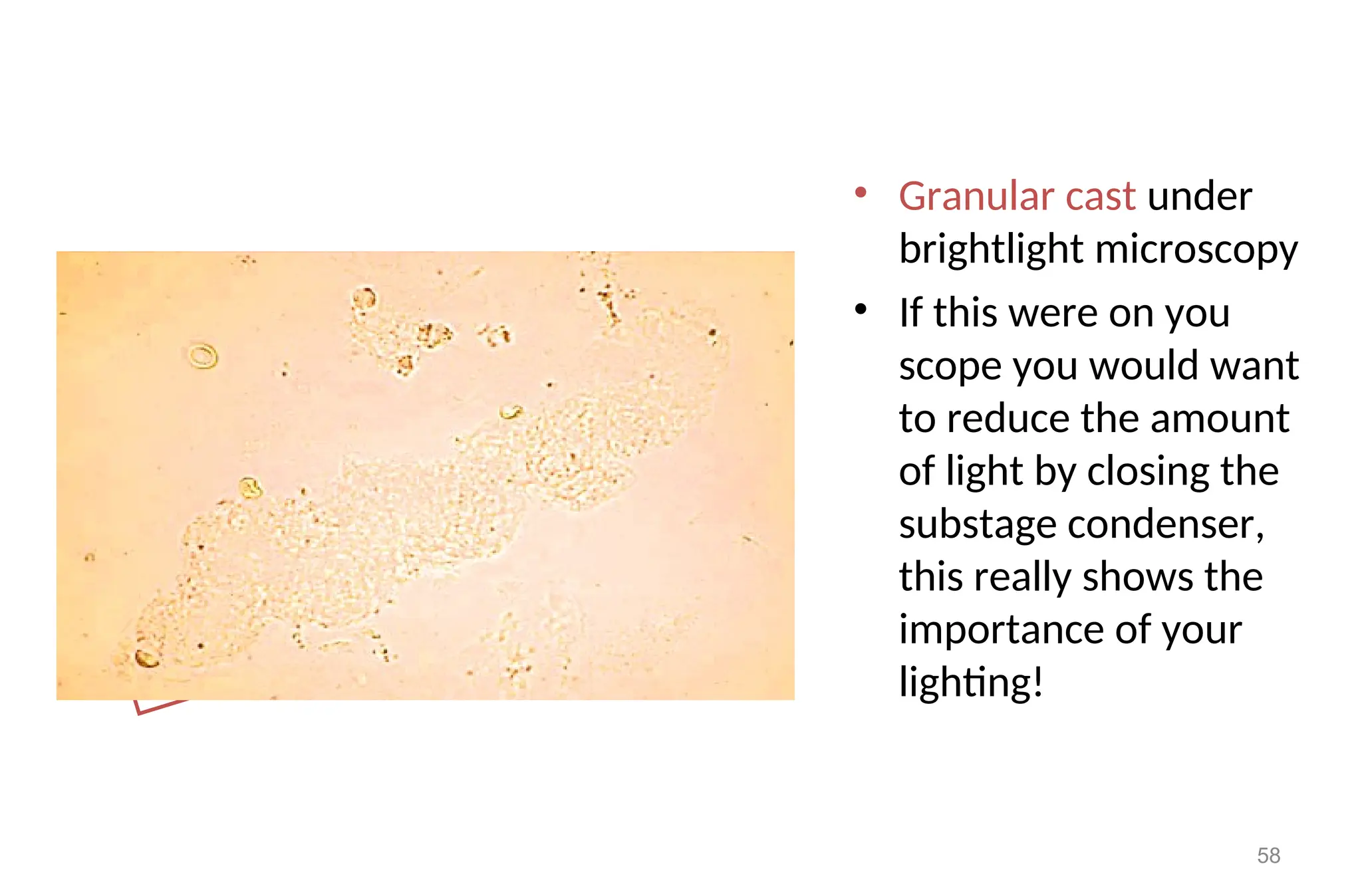 • Granular cast under
brightlight microscopy
• If this were on you
scope you would want
to reduce the amount
of light by closing the
substage condenser,
this really shows the
importance of your
lighting!
58
 