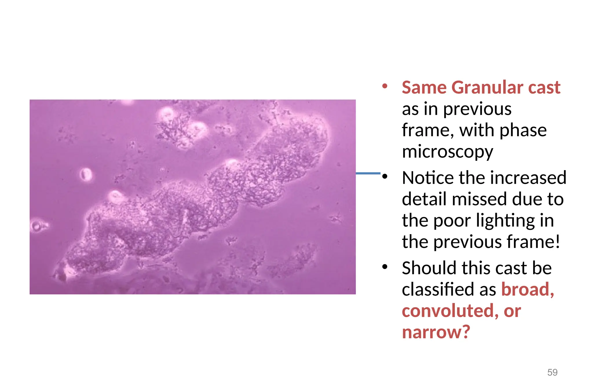 • Same Granular cast
as in previous
frame, with phase
microscopy
• Notice the increased
detail missed due to
the poor lighting in
the previous frame!
• Should this cast be
classified as broad,
convoluted, or
narrow?
59
 