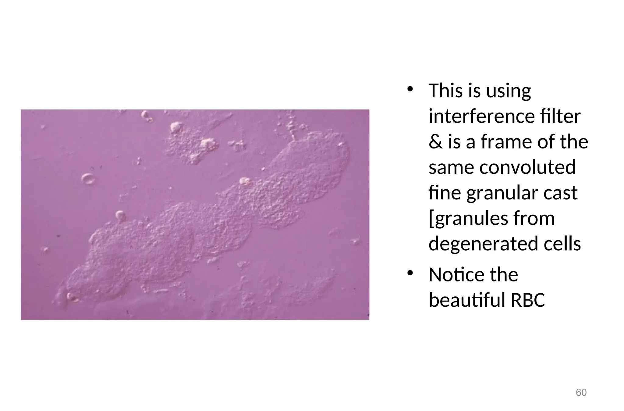 • This is using
interference filter
& is a frame of the
same convoluted
fine granular cast
[granules from
degenerated cells
• Notice the
beautiful RBC
60
 