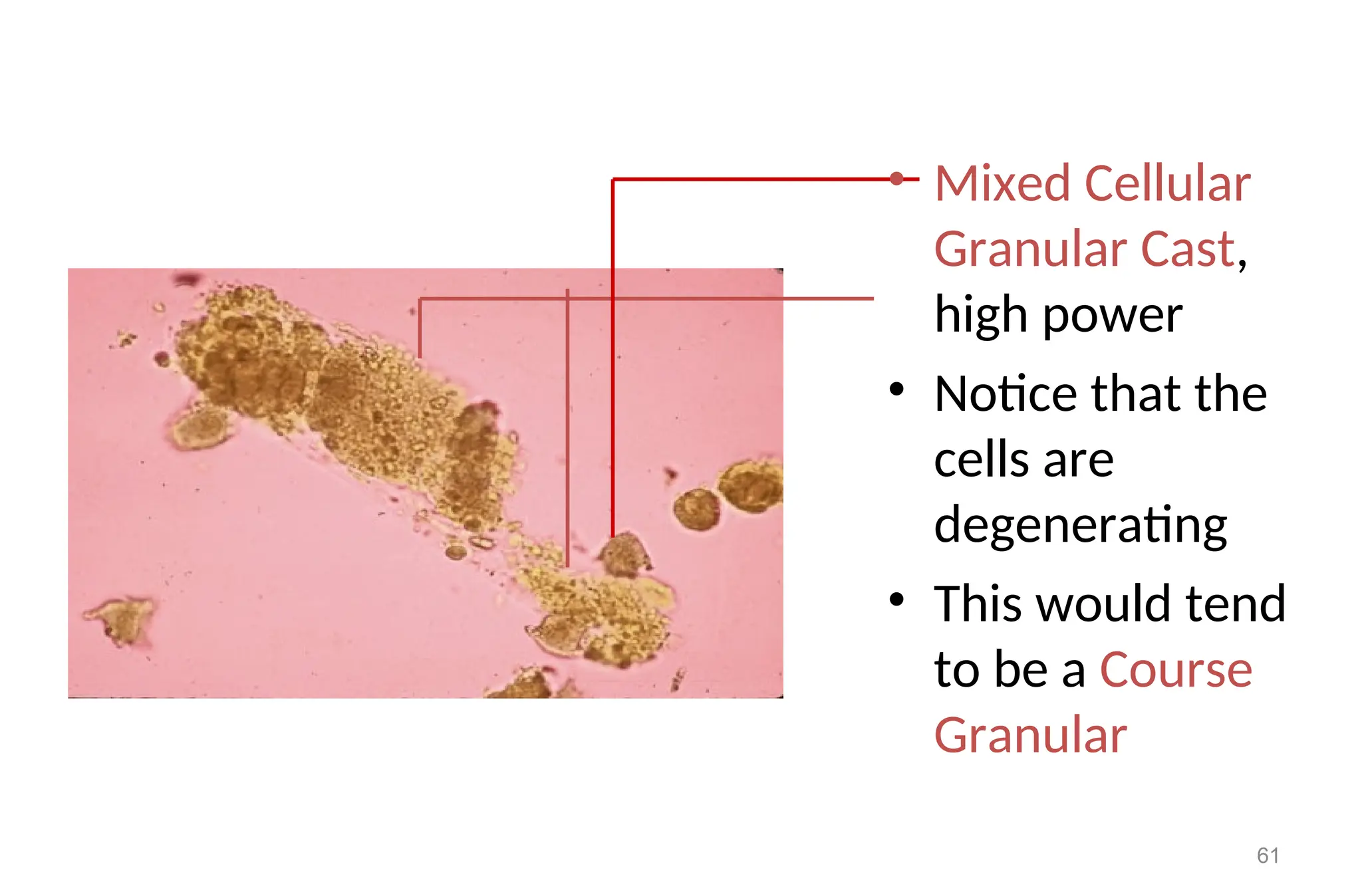 • Mixed Cellular
Granular Cast,
high power
• Notice that the
cells are
degenerating
• This would tend
to be a Course
Granular
61
 