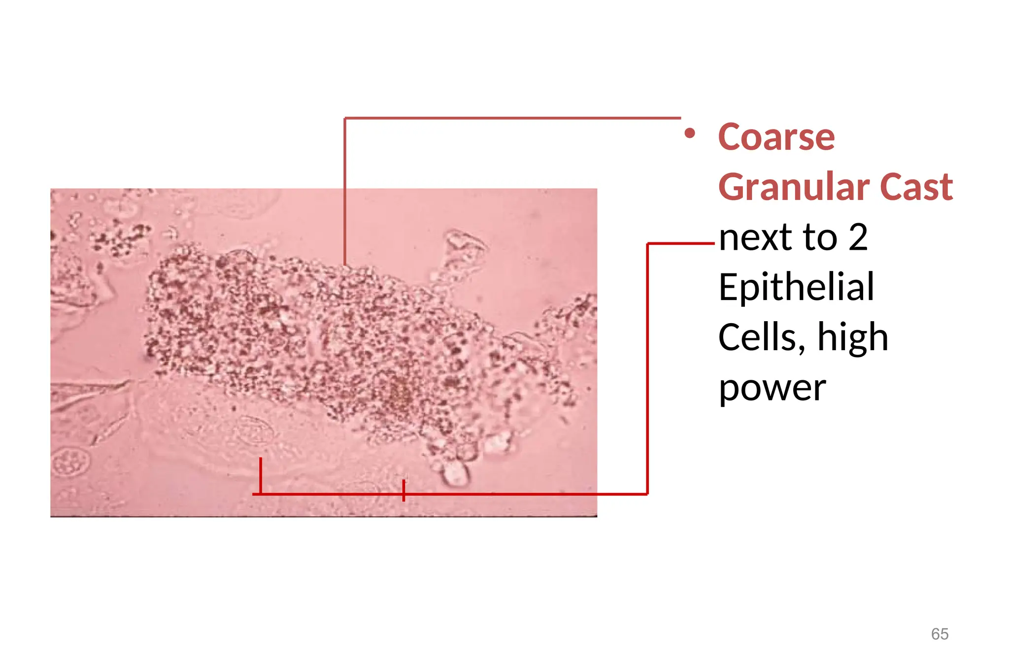 • Coarse
Granular Cast
next to 2
Epithelial
Cells, high
power
65
 