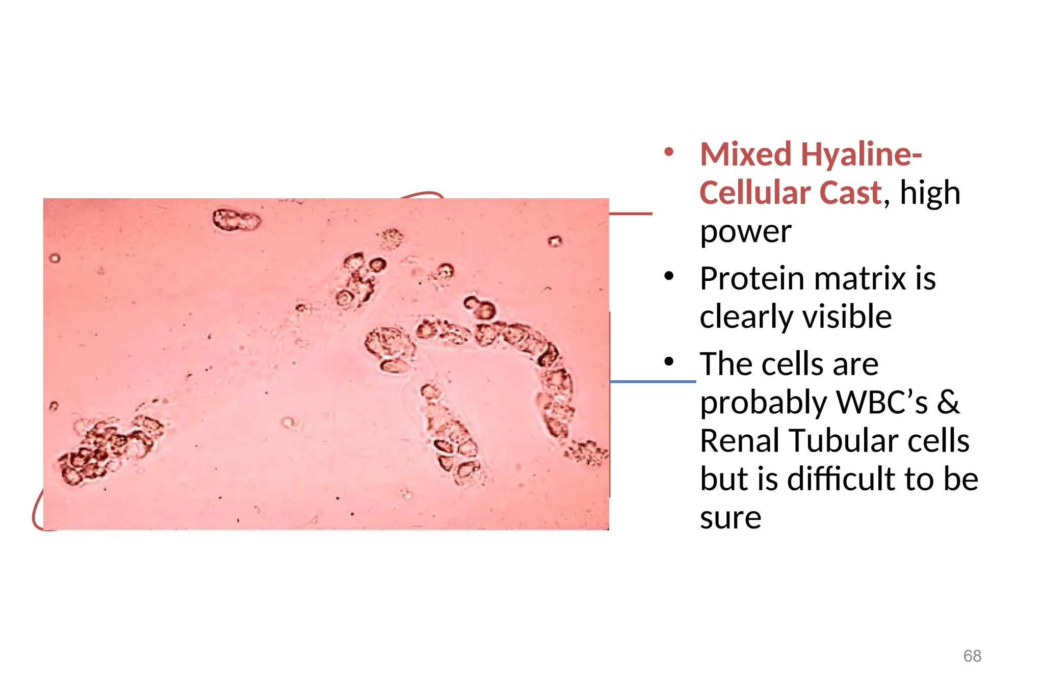 • Mixed Hyaline-
Cellular Cast, high
power
• Protein matrix is
clearly visible
• The cells are
probably WBC’s &
Renal Tubular cells
but is difficult to be
sure
68
 