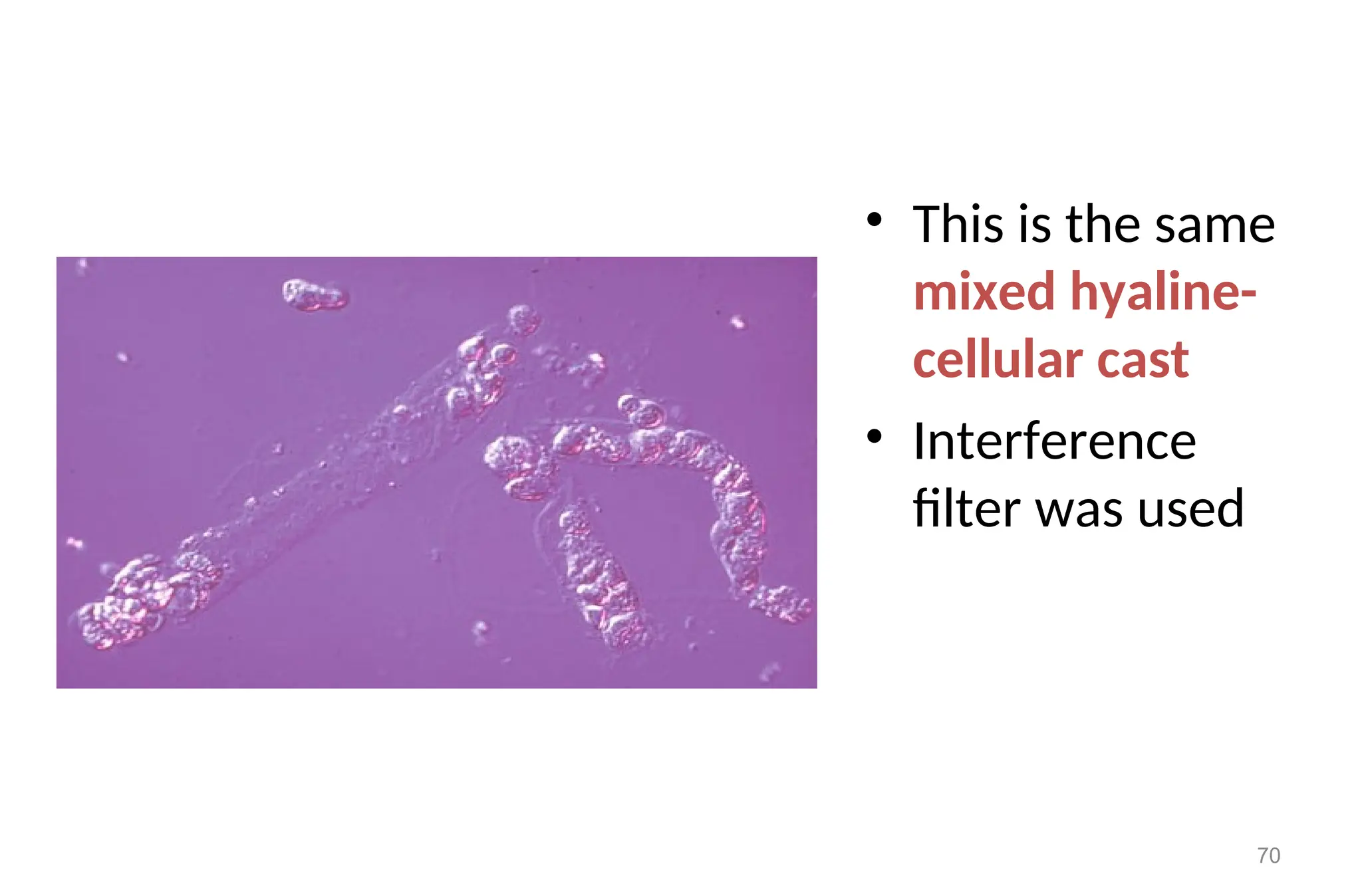 • This is the same
mixed hyaline-
cellular cast
• Interference
filter was used
70
 