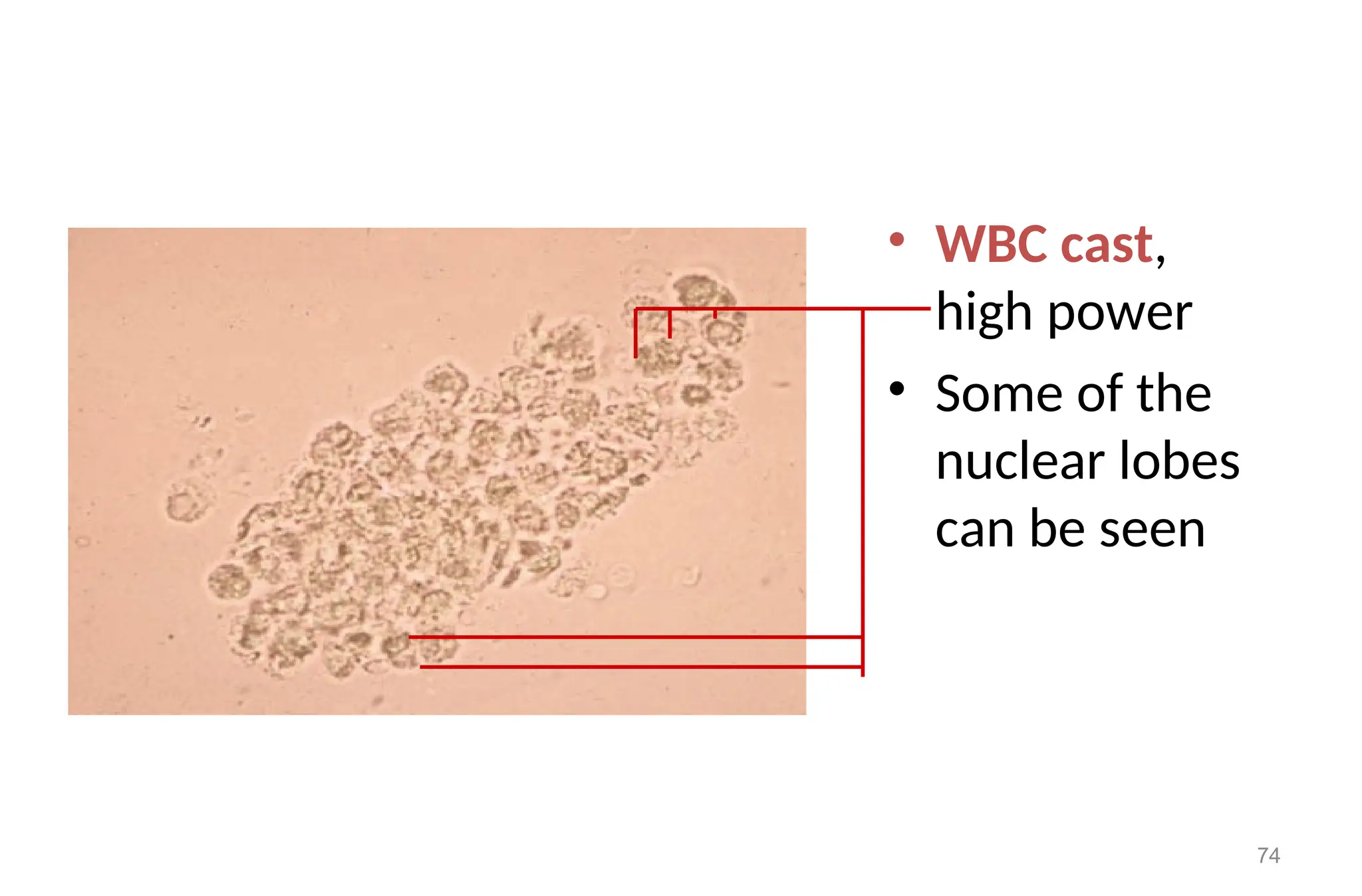 • WBC cast,
high power
• Some of the
nuclear lobes
can be seen
74
 