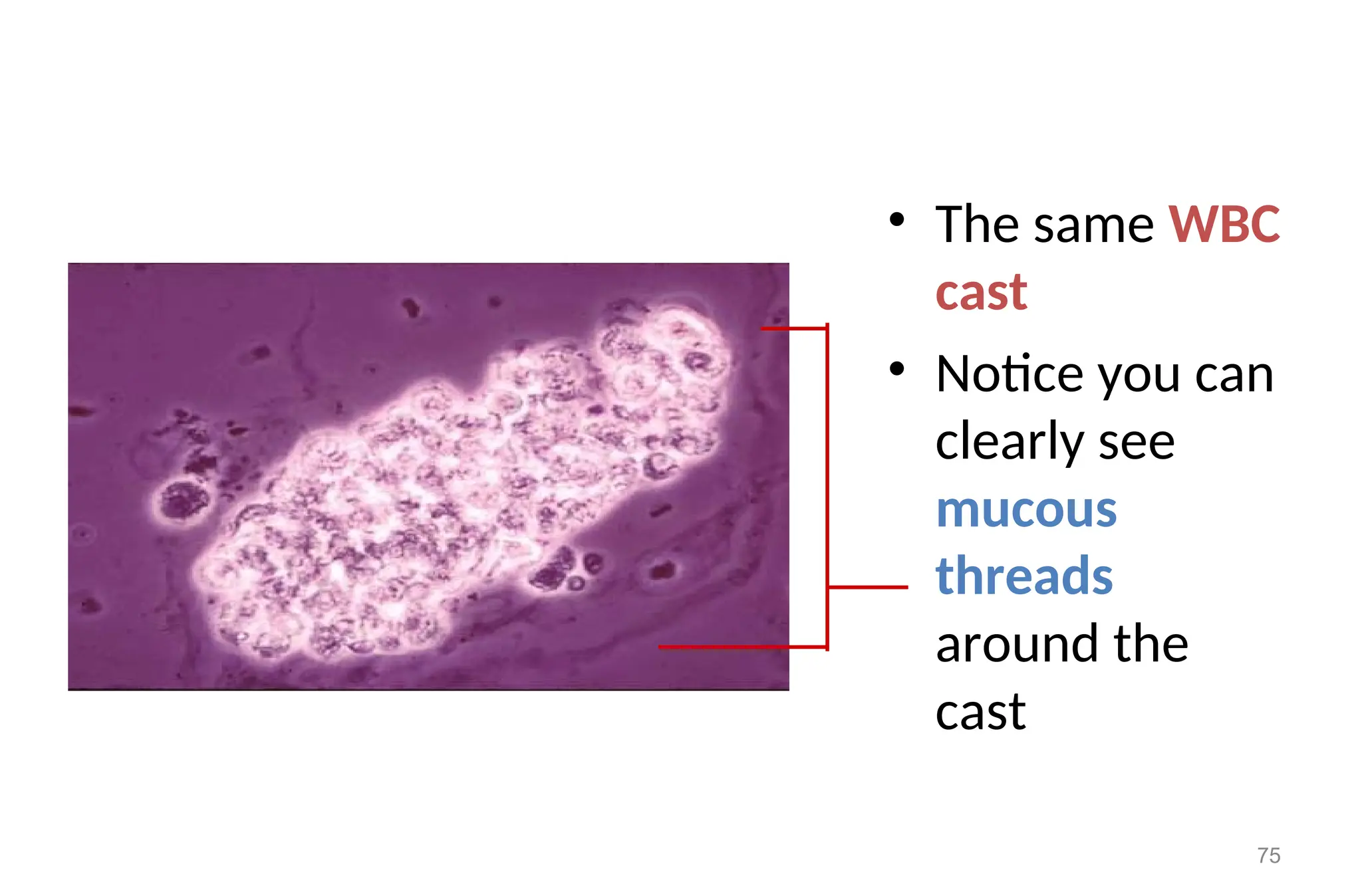 • The same WBC
cast
• Notice you can
clearly see
mucous
threads
around the
cast
75
 