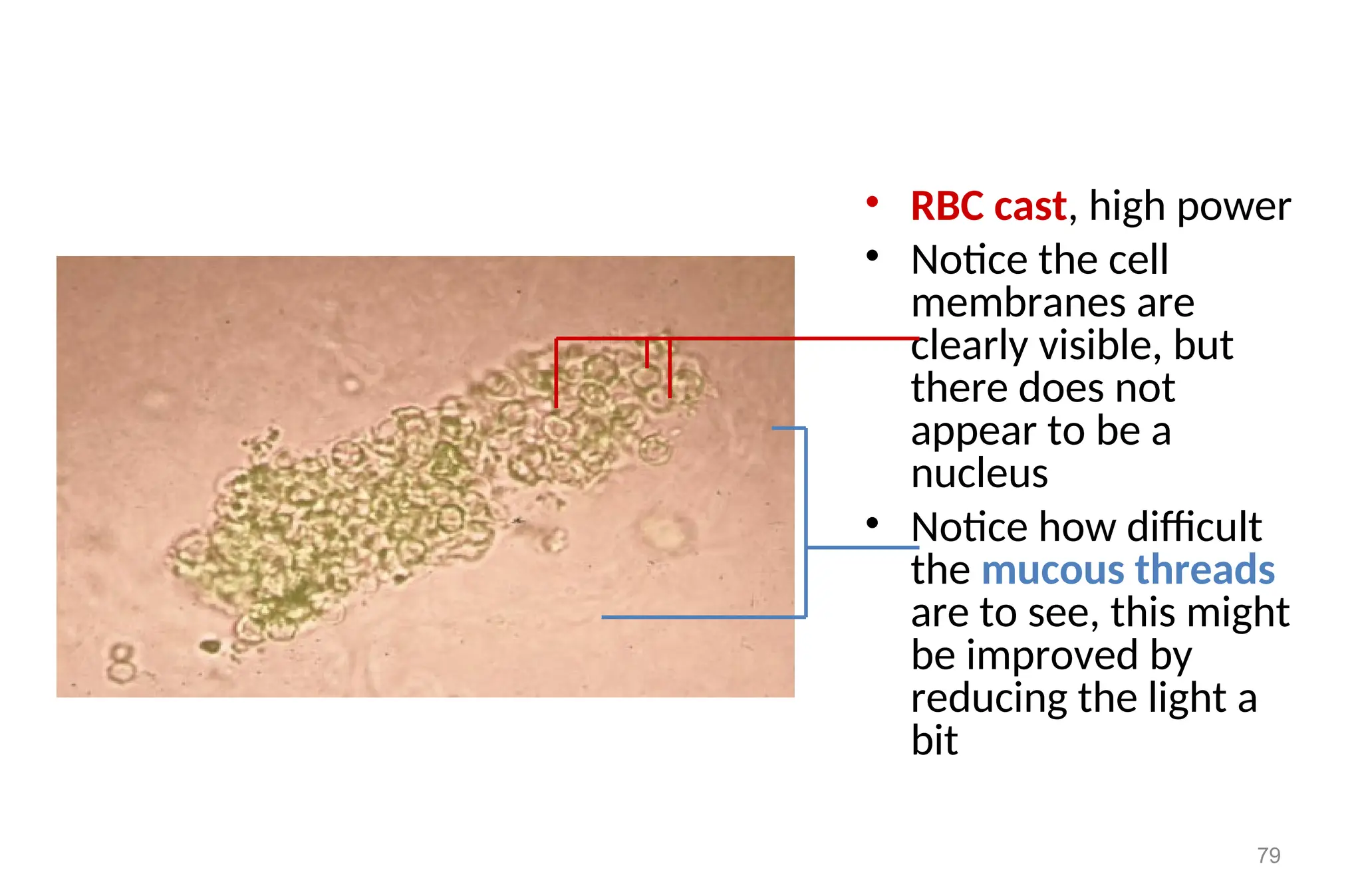 • RBC cast, high power
• Notice the cell
membranes are
clearly visible, but
there does not
appear to be a
nucleus
• Notice how difficult
the mucous threads
are to see, this might
be improved by
reducing the light a
bit
79
 