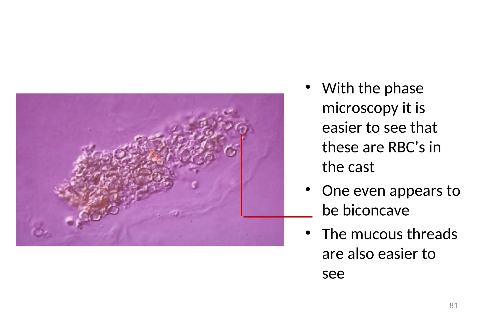 • With the phase
microscopy it is
easier to see that
these are RBC’s in
the cast
• One even appears to
be biconcave
• The mucous threads
are also easier to
see
81
 
