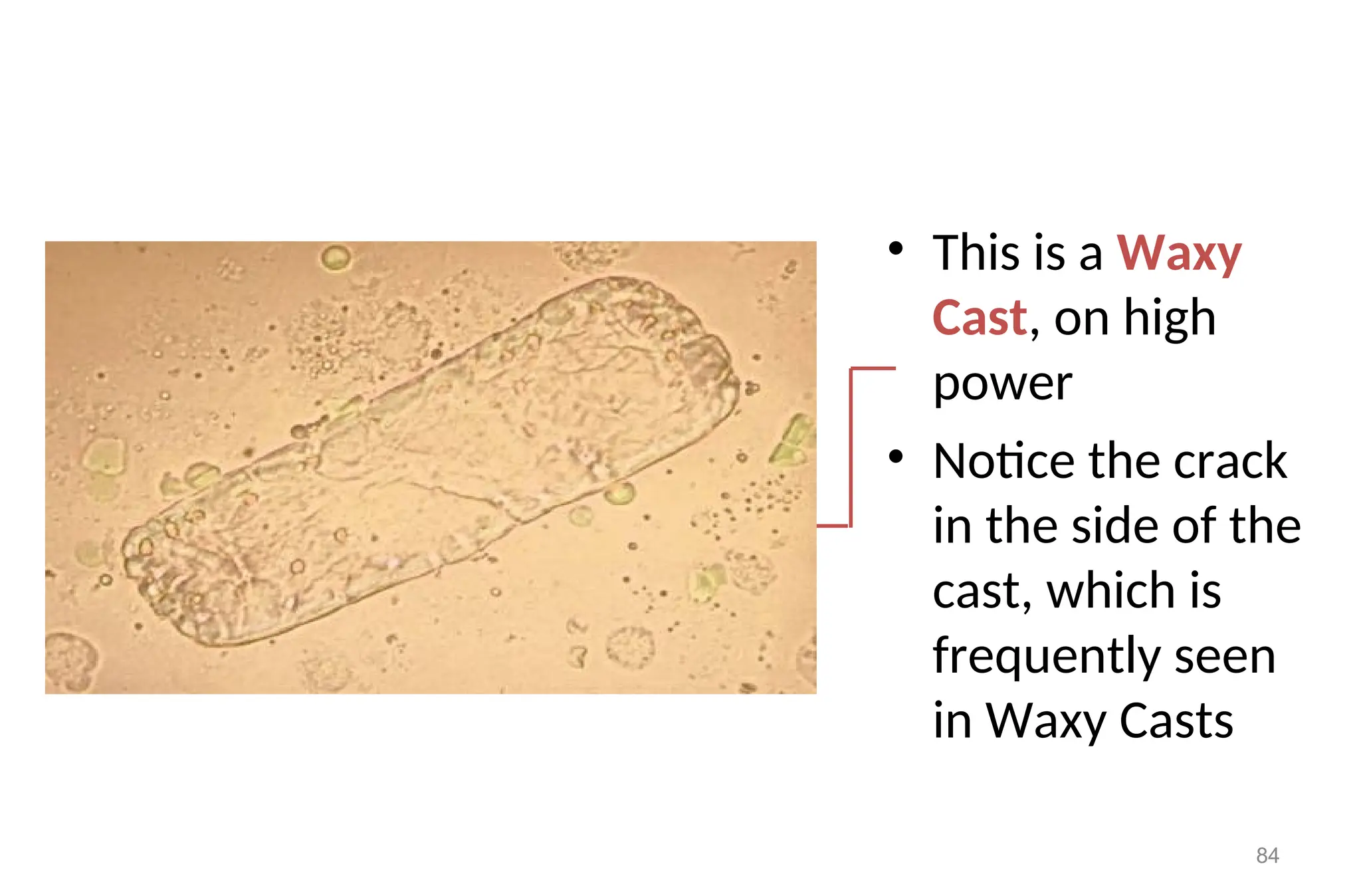 • This is a Waxy
Cast, on high
power
• Notice the crack
in the side of the
cast, which is
frequently seen
in Waxy Casts
84
 