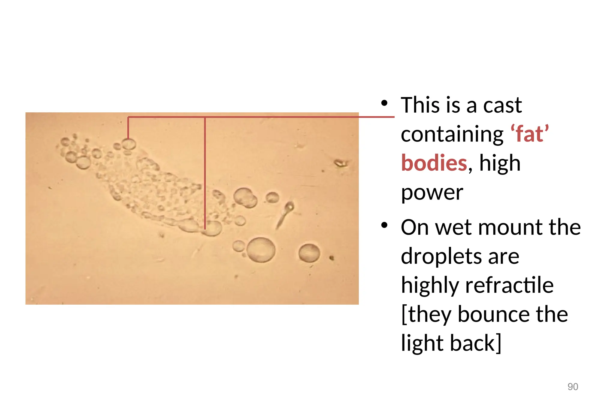 • This is a cast
containing ‘fat’
bodies, high
power
• On wet mount the
droplets are
highly refractile
[they bounce the
light back]
90
 