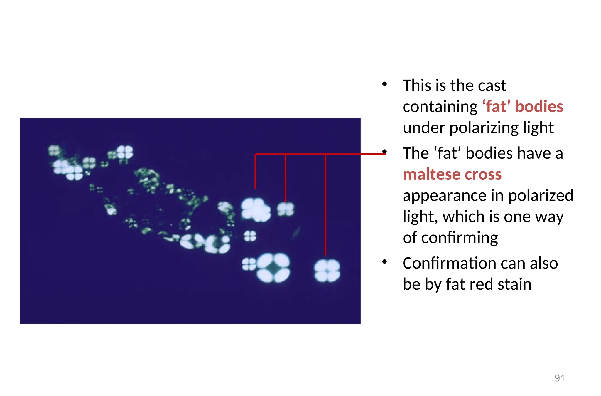 • This is the cast
containing ‘fat’ bodies
under polarizing light
• The ‘fat’ bodies have a
maltese cross
appearance in polarized
light, which is one way
of confirming
• Confirmation can also
be by fat red stain
91
 