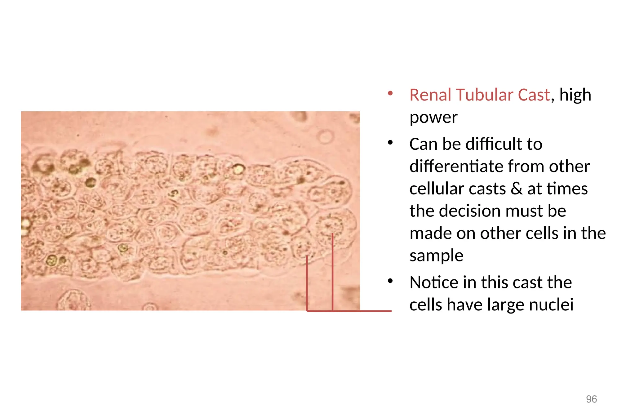 • Renal Tubular Cast, high
power
• Can be difficult to
differentiate from other
cellular casts & at times
the decision must be
made on other cells in the
sample
• Notice in this cast the
cells have large nuclei
96
 