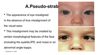 December 31, 2025
A.Pseudo-strabismus
 The appearance of eye misaligned
in the absence of true misalignment of
the visual axes.
 This misalignment may be created by
certain morphological features of the face
(including the eyelids,IPD, and nose) or an
abnormal angle kappa.
 