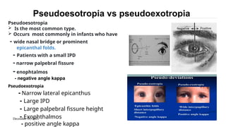 December 31, 2025
Pseudoesotropia vs pseudoexotropia
Pseudoesotropia
 Is the most common type.
 Occurs most commonly in infants who have
- wide nasal bridge or prominent
epicanthal folds.
- Patients with a small IPD
- narrow palpebral fissure
- enophtalmos
- negative angle kappa
Pseudoexotropia
- Narrow lateral epicanthus
- Large IPD
- Large palpebral fissure height
- Exophthalmos
- positive angle kappa
 