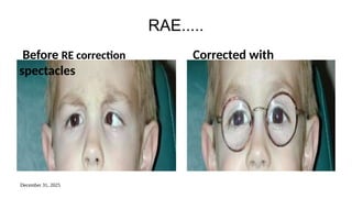 December 31, 2025
RAE.....
Before RE correction Corrected with
spectacles
 