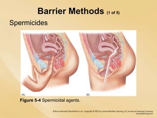 Barrier Methods (1 of 5)
Spermicides
Figure 5-4 Spermicidal agents.
 