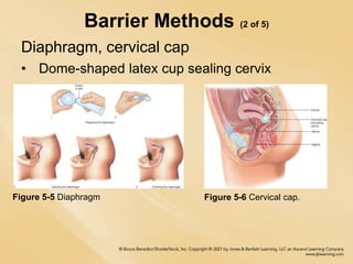 Barrier Methods (2 of 5)
Diaphragm, cervical cap
• Dome-shaped latex cup sealing cervix
Figure 5-5 Diaphragm Figure 5-6 Cervical cap.
 