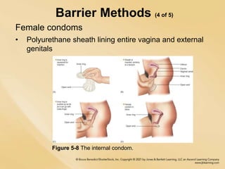 Barrier Methods (4 of 5)
Female condoms
• Polyurethane sheath lining entire vagina and external
genitals
Figure 5-8 The internal condom.
 