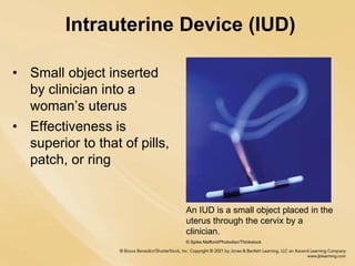 Intrauterine Device (IUD)
• Small object inserted
by clinician into a
woman’s uterus
• Effectiveness is
superior to that of pills,
patch, or ring
An IUD is a small object placed in the
uterus through the cervix by a
clinician.
© Spike Mafford/Photodisc/Thinkstock
 