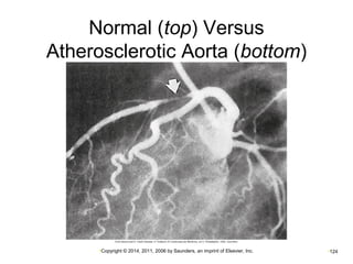 Normal (top) Versus 
Atherosclerotic Aorta (bottom) 
•Copyright © 2014, 2011, 2006 by Saunders, an imprint of Elsevier, Inc. •124 
 