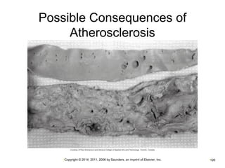 Possible Consequences of 
Atherosclerosis 
•Copyright © 2014, 2011, 2006 by Saunders, an imprint of Elsevier, Inc. •126 
 