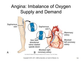 Angina: Imbalance of Oxygen 
Supply and Demand 
•Copyright © 2014, 2011, 2006 by Saunders, an imprint of Elsevier, Inc. •132 
 