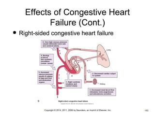 Effects of Congestive Heart 
Failure (Cont.) 
 Right-sided congestive heart failure 
•Copyright © 2014, 2011, 2006 by Saunders, an imprint of Elsevier, Inc. •153 
 