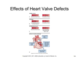 Effects of Heart Valve Defects 
•Copyright © 2014, 2011, 2006 by Saunders, an imprint of Elsevier, Inc. •164 
 