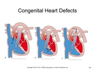 Congenital Heart Defects 
•Copyright © 2014, 2011, 2006 by Saunders, an imprint of Elsevier, Inc. •166 
 