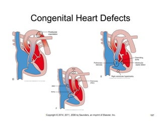 Congenital Heart Defects 
•Copyright © 2014, 2011, 2006 by Saunders, an imprint of Elsevier, Inc. •167 
 