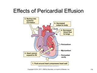Effects of Pericardial Effusion 
•Copyright © 2014, 2011, 2006 by Saunders, an imprint of Elsevier, Inc. •176 
 